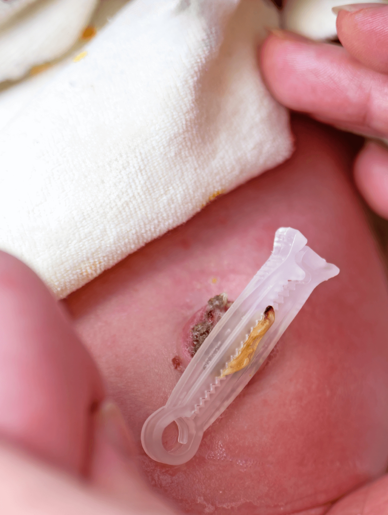 How to Properly Put a Diaper on a Newborn With an Unhealed Umbilical Cord